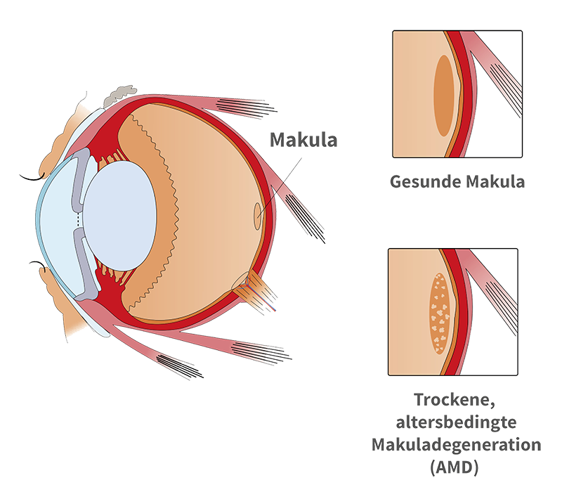 altersbedingte-Makuladegeneration
